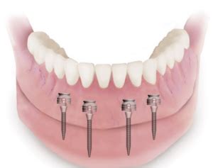 mini_implants_procedure - Gentle Dental