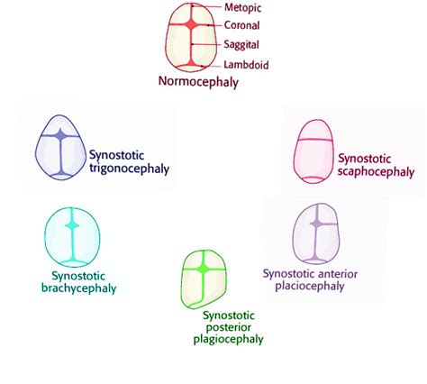 Figure Craniosynostosis Image Courtesy Dr Chaigasame Statpearls