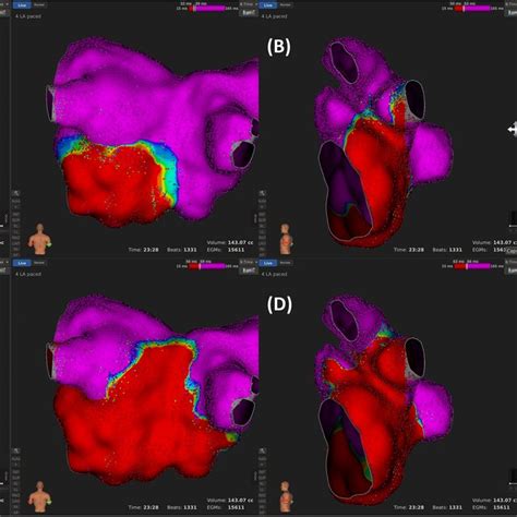 Examples Of A Left Superior Pulmonary Vein Lspv Antral Activation