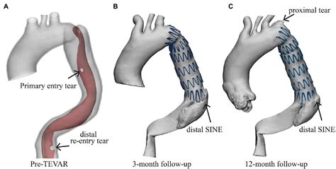 Frontiers Patient Specific Virtual Stent Graft Deployment For Type B