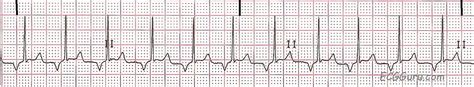 ECG Basics: Retrograde P Waves | ECG Guru - Instructor Resources