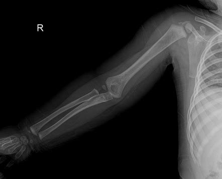 Supracondylar Fracture Radiology Case Radiopaedia Org