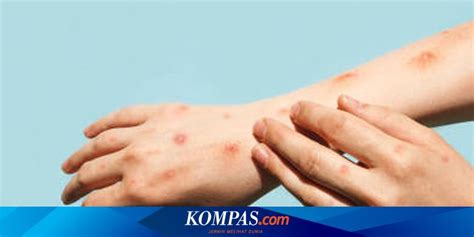 Berita Harian Perbedaan Campak Dan Cacar Air Terbaru Hari Ini