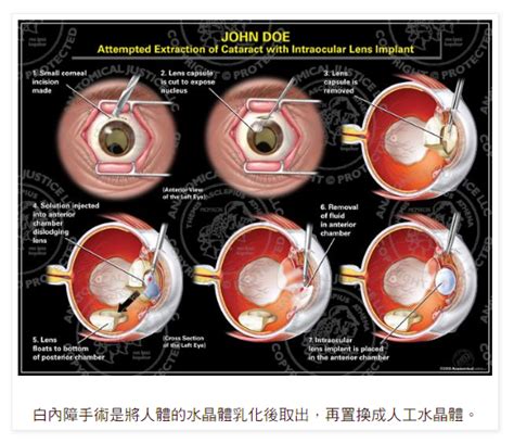 社團法人台灣青光眼關懷協會