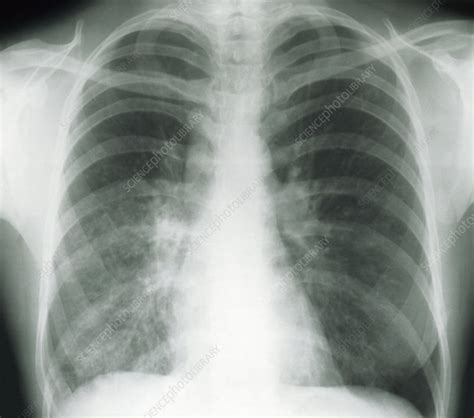 Tuberculosis X-ray - Stock Image - M270/0178 - Science Photo Library