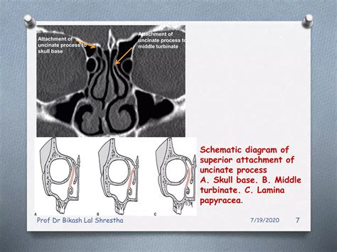 All about uncinate process of nose and paranasal sinuses | PPT | Free ...