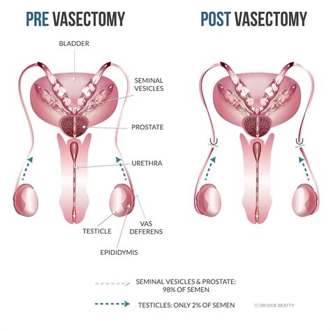 Vasectomy Understanding The Procedure Benefits And