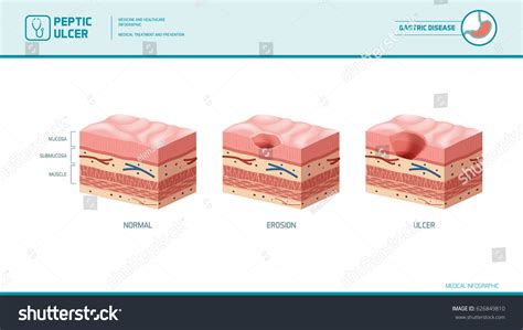 Stomach Erosion Peptic Ulcer Stages Infographic Stock Vector Royalty Free 626849810 Shutterstock