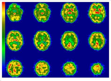 Regional Cerebral Blood Flow Imaging Using Single Photon Emission