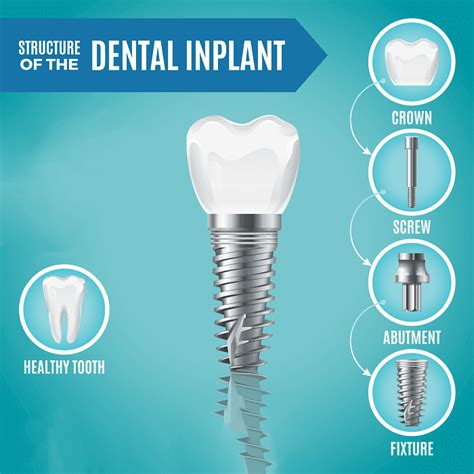 Components Of Your Dental Implant Dentist In Ellicott City Md