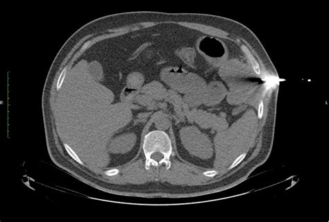 Ct Guided Needle Biospy Of The Mass Download Scientific Diagram