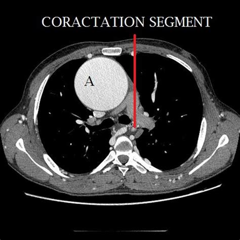 Ct Angiography Showing Critical Coarctation Of Aorta And The Ascending Download Scientific