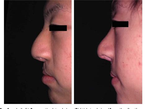 Figure 3 From Alar Groove Plasty Using A Subcutaneous Flap Technique In