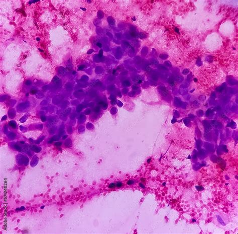 Breast lump(FNA Cytology): Proliferative breast disease with atypia, show cellular material ...