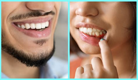 Healthy Gums Vs Unhealthy Gums