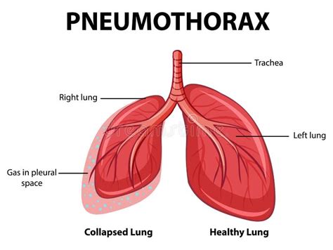 Pneumothorax Diagram Stock Illustrations – 103 Pneumothorax Diagram Stock Illustrations, Vectors ...