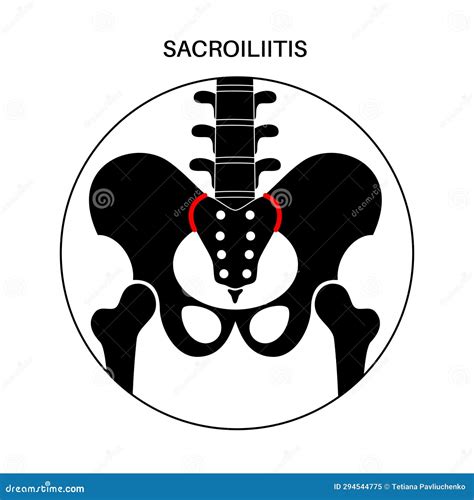 Sacroiliac Joints Linking The Pelvis And Lower Spine Front Cross