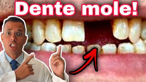 Por que os DENTES ficam MOLES Como deixá los MAIS FORTES YouTube