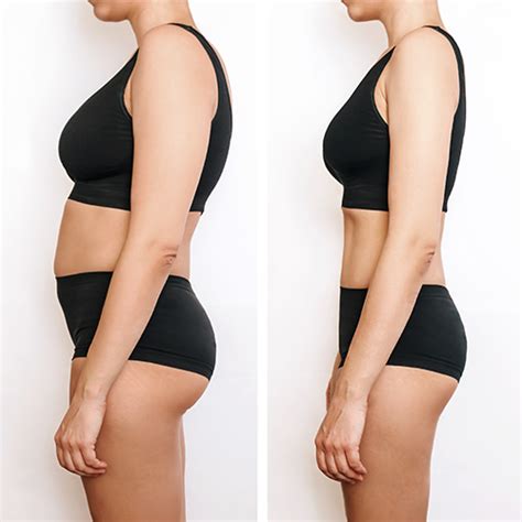 High Definition Liposuction Revision In Brazil Rosique Plastic Surgery