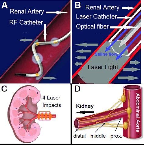 Scheme Showing A The Method Of Renal Denervation By Using A Spiral Download Scientific