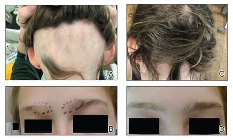 Alopecia Universalis Treatment