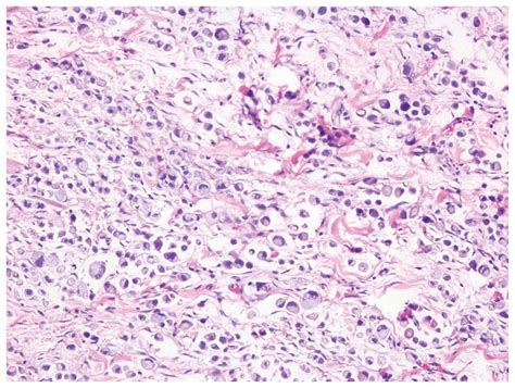 Memo Jagen Melbourne Signet Ring Cell Adenocarcinoma Tafel Randstein