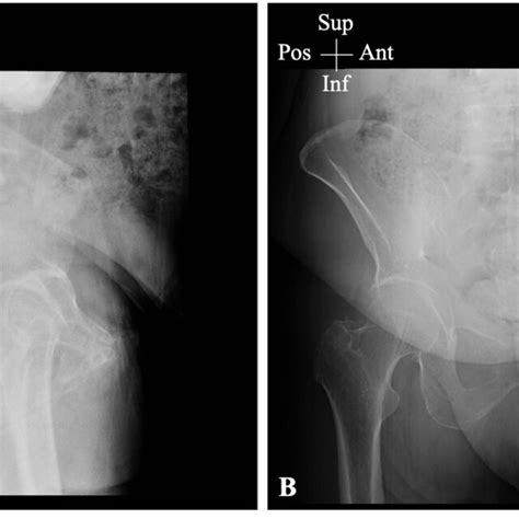 Plain Pelvic X Ray Lateral A And Posteroanterior B Views Of The