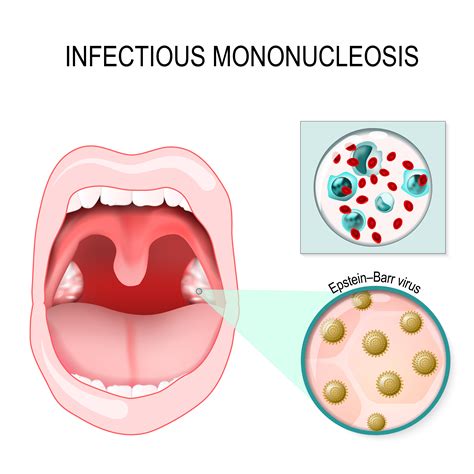 Comunidad Mimed Infecciones 17 De Mayo 2023