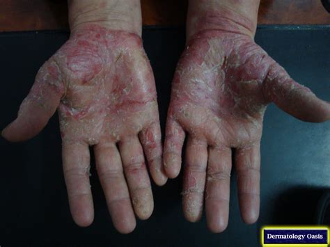 palmar psoriasis - pictures, photos