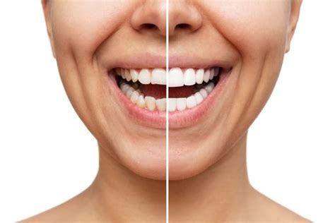 Zirconia Veneers Achieve Your Dream Smile