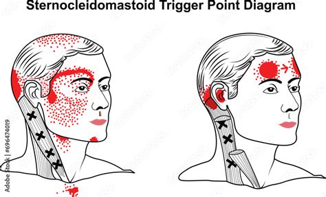 Sternocleidomastoid Trigger Point Vector Diagram Stock Vector Adobe Stock