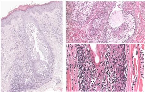 Folliculotropic Mycosis Fungoides Hair Follicle Hyperplasia With