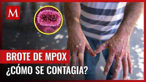 ¿qué Es El Mpox Y Cómo Se Contagia La Organización Mundial De La Salud