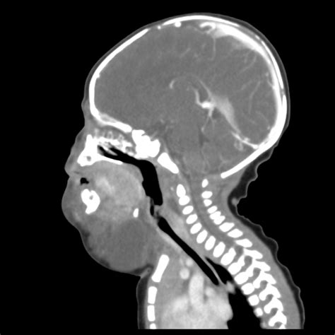 Cystic Hygroma Image