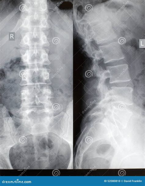 脊髓x 射线 库存照片 图片 包括有 报表 爱好健美者 椎骨 骨头的 滑倒 人力 精神创伤 52080810