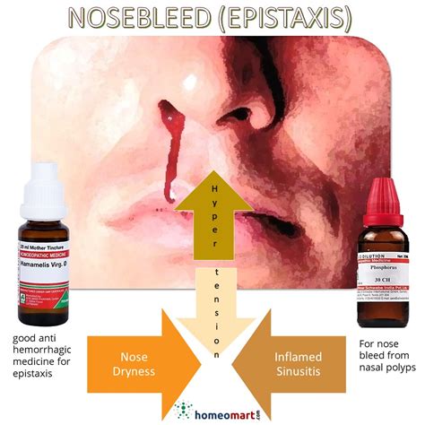 Nose bleeding treatment home remedy, Natural & Safe