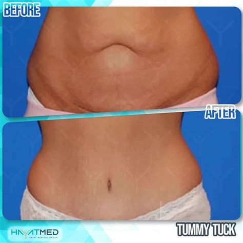 Tummy Tuck In Turkey Best Doctors Latest Techniques Price