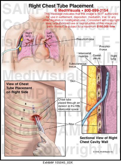 Chest Tube Thoracostomy SpringerLink, 46% OFF