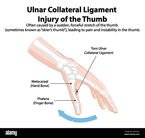 Illustration of thumb ligament injury and affected bones Stock Vector Image & Art - Alamy