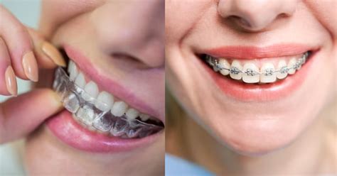 Invisalign Vs Traditional Braces Choose Your Best Smile TheDentech