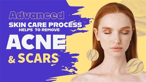 Advanced Skin Care Process Helps To Remove Acne Or Scars Vwb Blog