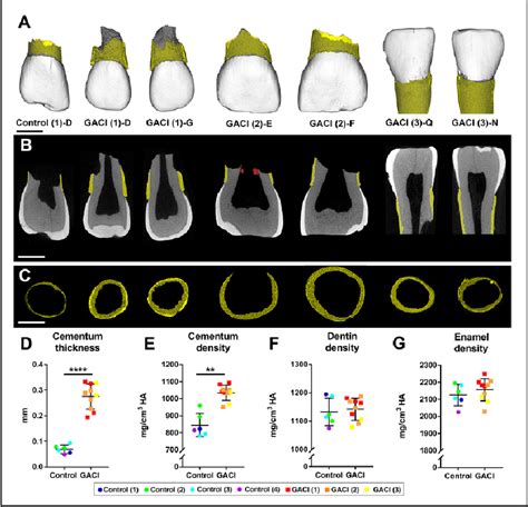 Figure 1 From Hypercementosis Associated With Enpp1 Mutations And Gaci