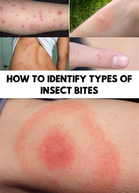 Insect Bites How To Identify Types Of Insect Bites Bites On Skin