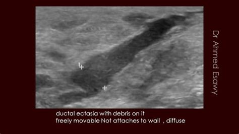 Breast Duct Ectasia Us Mammogram Mri Ppt