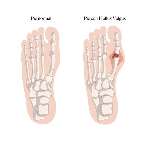 Qué son los juanetes o Hallux Valgus y cómo prevenirlos SBV