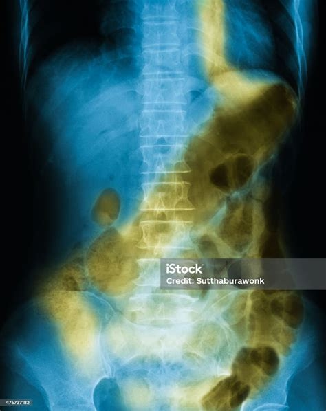 Xray Image Of Plain Abdomen Supine Stock Photo Download Image Now