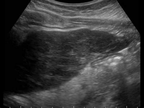 Abdomen and retroperitoneum | 1.1 Liver : Case 1.1.15 Hepatitis | Ultrasound Cases