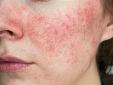 Rosacea Symptome Ursachen Und Behandlung