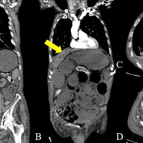 A D Is Showing An Arterial Phase Contrast Enhanced Ct With Axial Slices