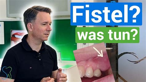 Fistel Am Kiefer Was Tun Zahn Ziehen Implantat YouTube